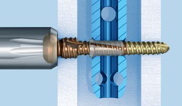 How does ASLS work? The system consists of a screw with three outer diameters and a resorbable sleeve.