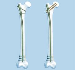 fractures closer to the metaphyseal area or in poor quality bone.