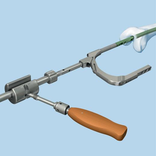 Retrograde Approach Inserting Nail If more insertion forces are necessary, attach the hammer guide to the connector and use the combined hammer in sliding mode.