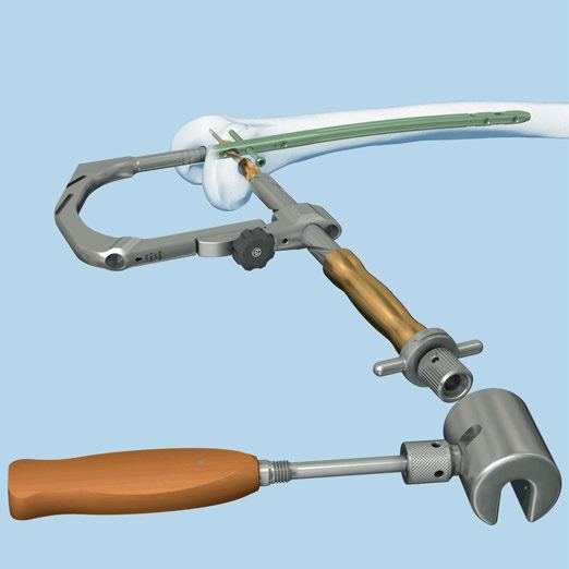 Retrograde Approach Spiral Blade Locking (Optional) Use light, controlled blows of the combined hammer in the fixed position to seat the spiral blade. Advancement should be monitored radiographically.