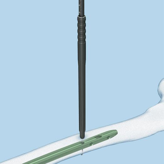 Retrograde Approach Freehand Locking 5 Measure for length of locking screw Instrument 03.010.072 Depth Gauge for Locking Screws, measuring range up to 110 mm, for No. 03.010.063 or 03.