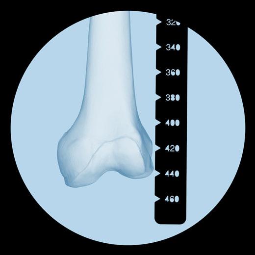 Antegrade Approach Opening the Proximal Femur Move the image intensifier toward the distal femur, align the proximal end of the ruler with the skin marking and record an AP x-ray of the distal femur.