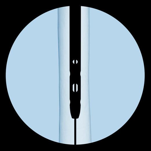 Insert the nail until the proximal end is at or just below the level of the tip of the greater trochanter. Monitor nail passage across the fracture, control in two planes to avoid malalignment.