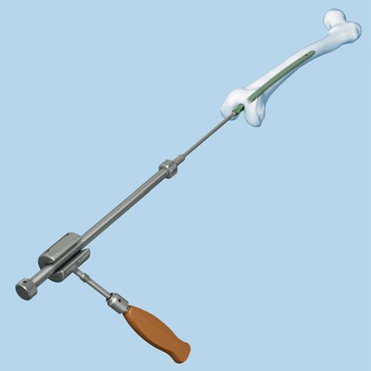 Implant Removal 5 Remove nail Instrument 03.010.056 Combined Hammer 700 g, can be mounted, for No. 357.220 or 03.010.522 Combined Hammer, 500 g Extract the nail by applying gentle blows with the combined hammer.