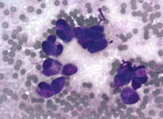 Low-grade ductal adenocarcinomas appear as a monomorphic population on cytology smears. The groups are flat and angulated. The monomorphic appearance is evident on histopathology specimens (Fig 12).