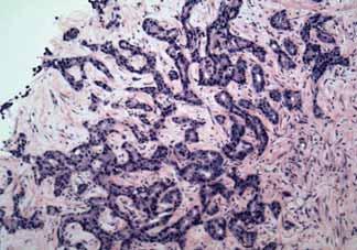 the breast, ovaries, and pancreas and may arise anywhere in the gastrointestinal tract. Mucinous bronchoalveolar carcinoma has similar features.