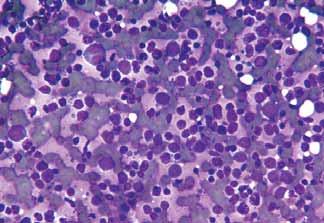 times the size of a normal lymphocyte) with nuclear membrane irregularities (Fig 25). Follicular lymphomas, mucosawith that of hepatocellular carcinoma on FNA and NCB.