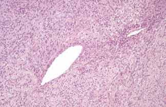 NCB can be used for histomorphological grading of follicular lymphomas and immunohistochemical studies.