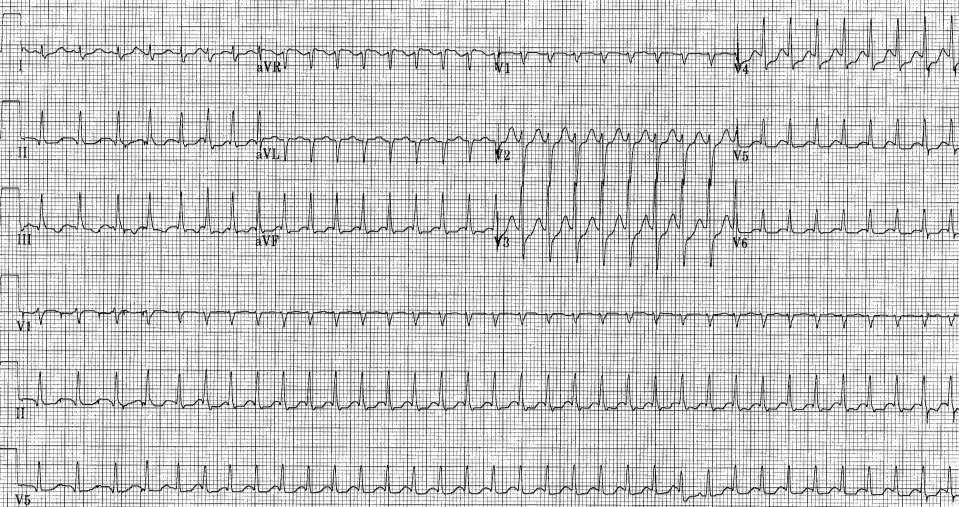 48 M with palpitations Typical or