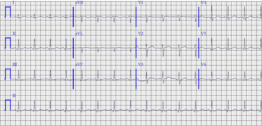 Baseline Typical AVNRT The P wave