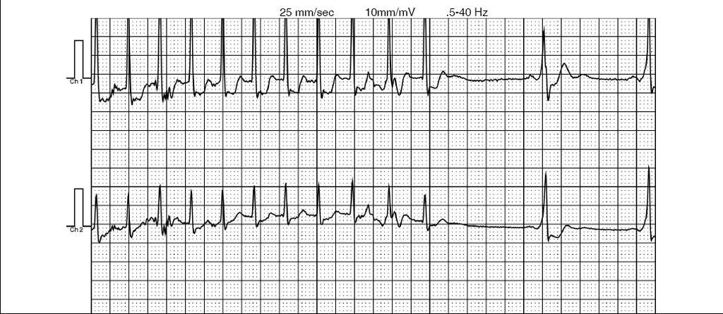 42 M with a history of palpitations since his teens AVNRT, AVRT, or AT?