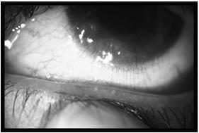 SCREENING EXAMINATION Evaluate face, eyelids, lashes, blink and lid closure 2. Evaluate tear film (TBUT using fluorescein strips) 3.