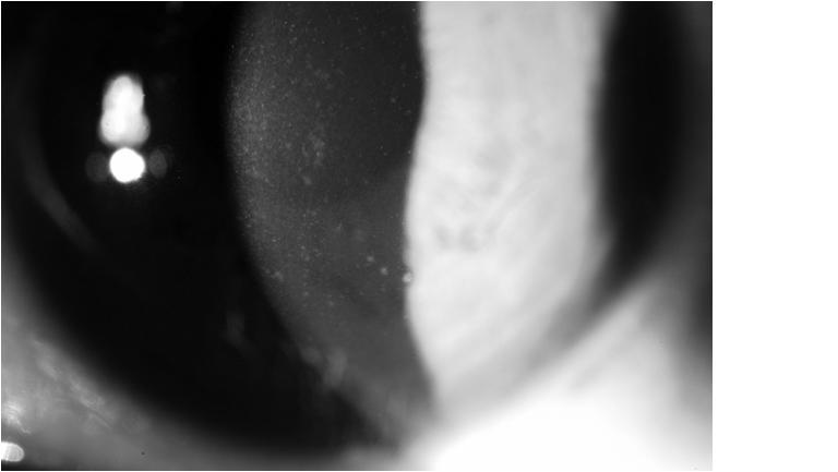 Carnt NA et al. Contact Lens-Related Adverse Events and the Silicone Hydrogel Lenses and Daily Wear Care System Used. Arch Ophthalmol.