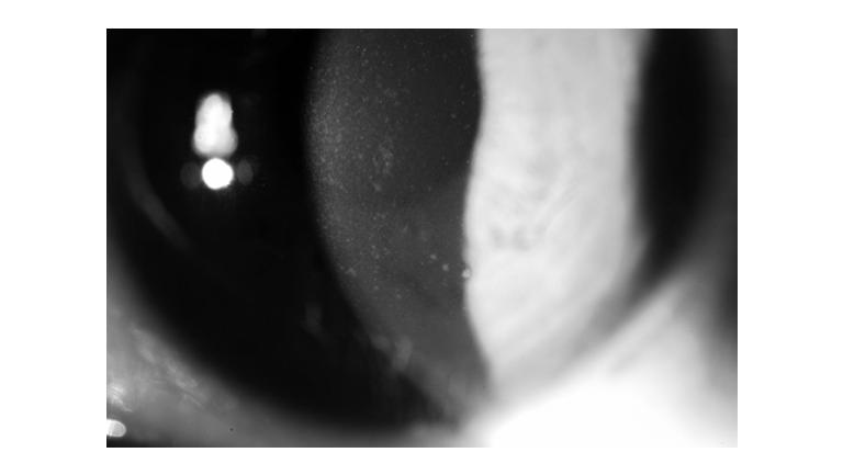 Caucasian female of 63 years old Fitted in RGP lenses for > 25 years Consult for reflex tearing and ocular discomfort lasting for a few years Tried many comfort drops, tear substitutes (drops +gels)