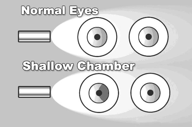 The eye will feel rock hard, and you can actually palpate the difference between the eyes with your fingers. One classic sign that patients often describe is seeing halos around lights.