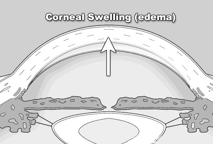 This corneal swelling also makes it hard for you to see into the eye, further complicating diagnosis and treatment.