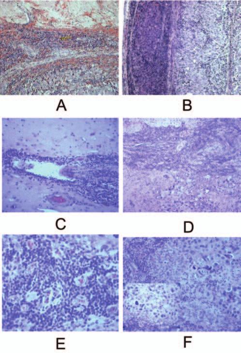 C: Hyaline degenerated scar tissue replacing destroyed tumor cell nests 3 years after GKS.
