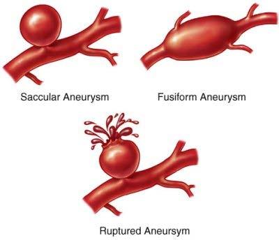 There are two types of aneurysms: a saccular aneurysm and a fusiform aneurysm. The differing shapes may affect treatment choices.