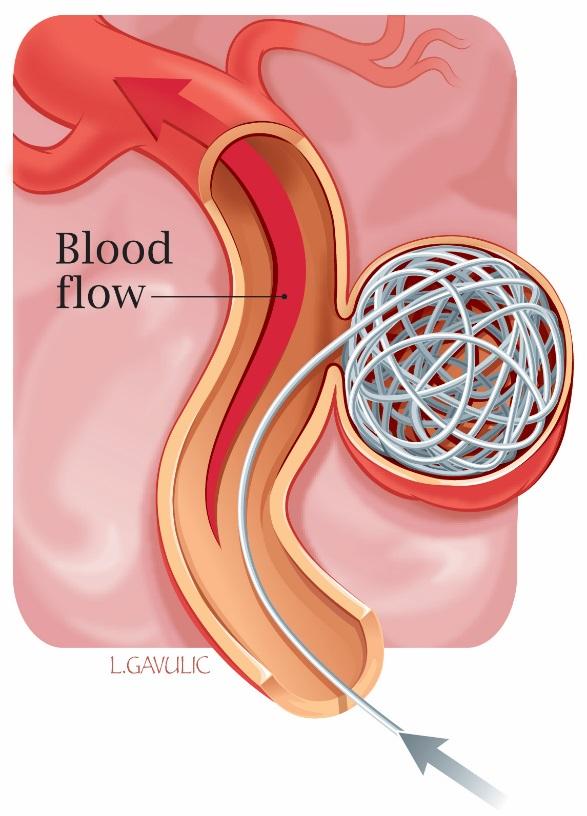 The clip cuts off the blood flow into the weakened area, and this causes the aneurysm to form a clot and shrink.