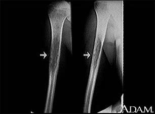 Ewing s Sarcoma Effects on adjacent structures May stimulate the periosteum to lay down new bone in sunray pattern or Codman s triangles Will destroy cortices of