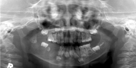 sinus, posterior mandible, and maxilla Non-Hodgkin s Lymphoma Radiographic features Shape and Borders Initial lesions are shaped like the host bone Long standing lesions can destroy the cortices of