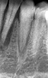 Radiographic features Effects on adjacent structures Periodontal ligament space will initially