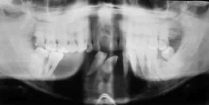 Cropped panoramic radiograph Originating in a cyst Uncommon lesion