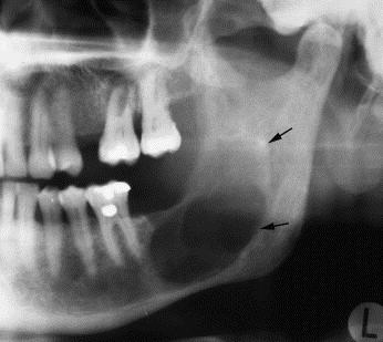 Originating in a cyst Location Tooth-bearing areas Most occur in the mandible Shape and Borders Initially