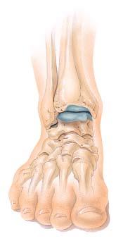 Arthroscopy of the Ankle Arthroscopy is used to find and treat many types of ankle problems. These include loose bodies and bone spurs.