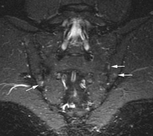 MRI of Sacroiliac Joints in Patients with nkylosing Spondylitis images (Fig. 1).