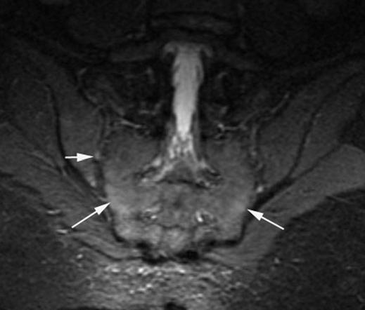 , oronal fat-saturated contrast-enhanced T1-weighted image shows moderate enhancement (arrows). D, oronal STIR image shows mild bilateral inferior edema of sacroiliac joint (arrows).