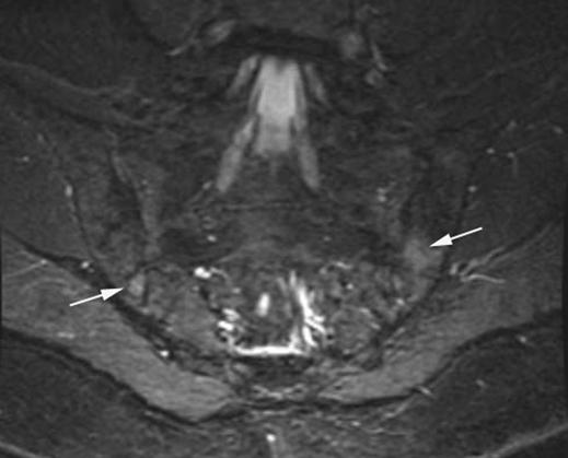 B, xial T1-weighted MR image shows sclerosis and fusion of sacroiliac joint (arrows).