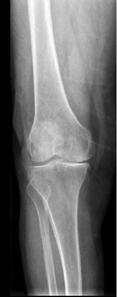 There is various treatment options according to the plain radiograph findings of osteoarthrosis combined with physical examination of the patient.