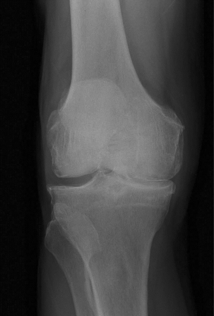 Normal Knee X-ray