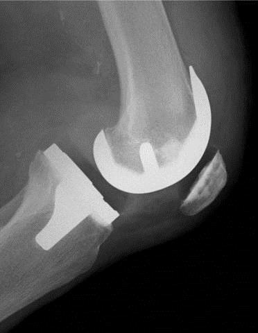 Replaced Knee X-ray Anterior
