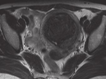 FDG PET/CT of Uterine Tumors cervical cancer: detection with integrated FDG PET/CT. Radiology 2006; 238:272 279 12.