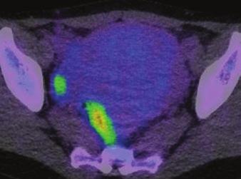 18 F-fluorodeoxyglucose positron emission tomography in uterine carcinosarcoma. Eur J Nucl Med Mol Imaging 2008; 35:484 492 Downloaded from www.