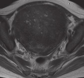 Kitajima et al. Fig. 4 45-year-old woman with diffuse adenomyosis.