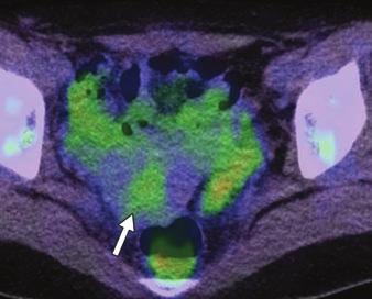 , On PET/CT image, endometrial hyperplasia (arrow) shows faint FDG uptake with maximum