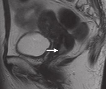 FDG PET/CT of Uterine Tumors Fig. 7 62-year-old woman with early-stage uterine cervical cancer.
