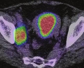 Federation of Gynecology and Obstetrics stage Ib). MRI shows right internal iliac lymphadenopathy measuring 2.