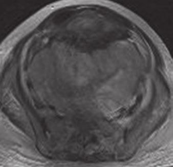 10 55-year-old woman with bilateral internal lymph node metastases due to endometrial cancer.
