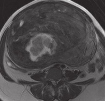 difficult to diagnose lymph node metastases because of size criterion.