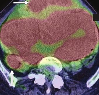, Huge uterine tumor shows heterogeneous high signal intensity with omentum involvement on T2- weighted