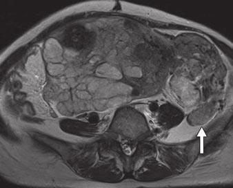 FDG PET/CT of Uterine Tumors Downloaded from www.ajronline.org by 37.44.205.