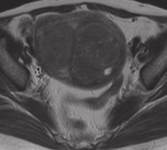 , MR image reveals hyperintense endometrial tumor showing extensive myometrial involvement with bands of
