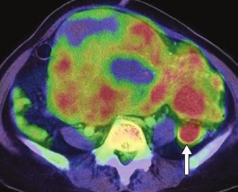 , On PET/CT image, huge uterine tumor shows uptake value of 8.2.