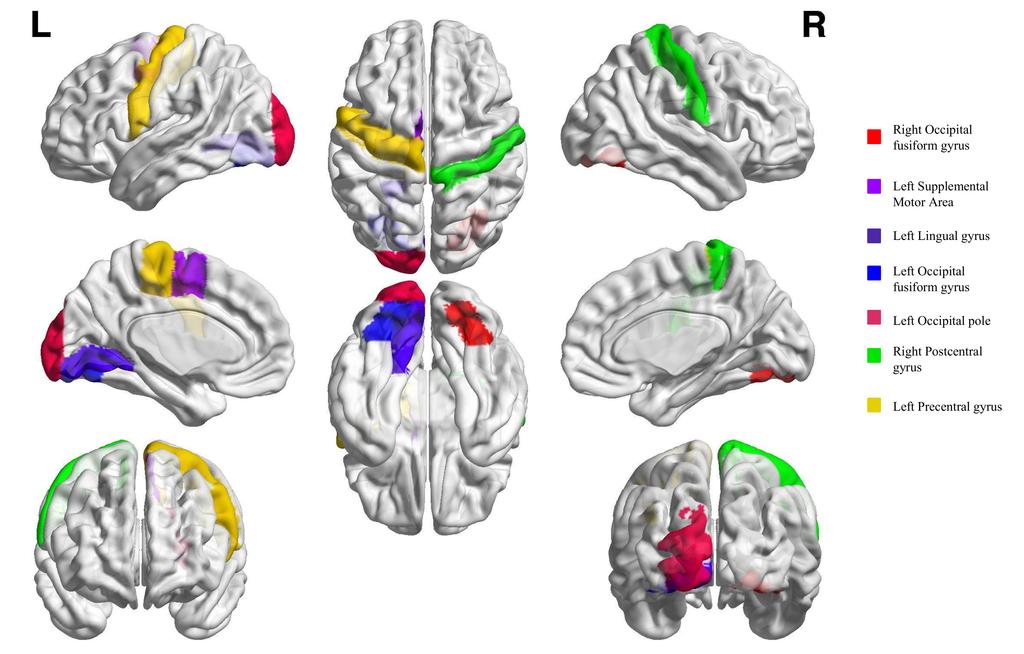 Figure 2: Brain regions significantly more represented in the mined biomarkers than expected in permutation distributions. These areas are predominantly located in the motor and visual cortices.
