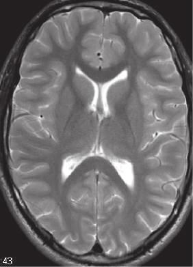 Brain Imaging Techniques 43 A C B C B Figure 2.2 Example of anatomical MRI scan (maybe one with a lesion?) AQ: Please determine maybe one with a lesion? scan times.