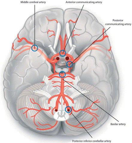 C) Common sites of cerebral aneurysms (alternate view).